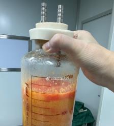 顺德水动力吸脂手术要做多久？